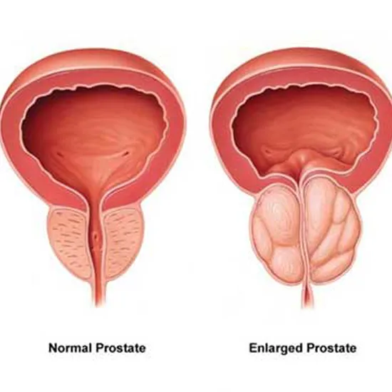 Transurethral Resection Of The Prostate TURP Test